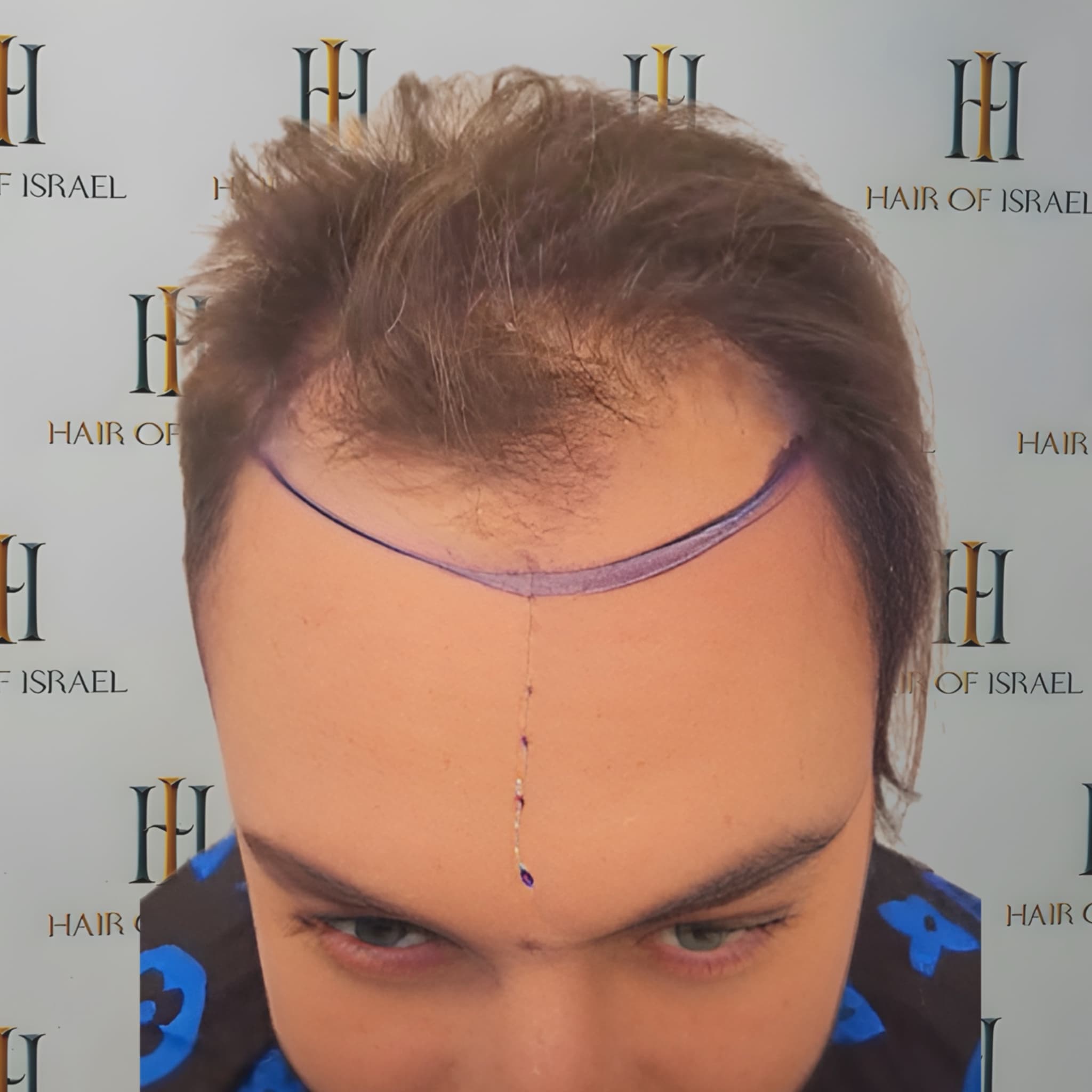 לפני השתלה — מטופל 1