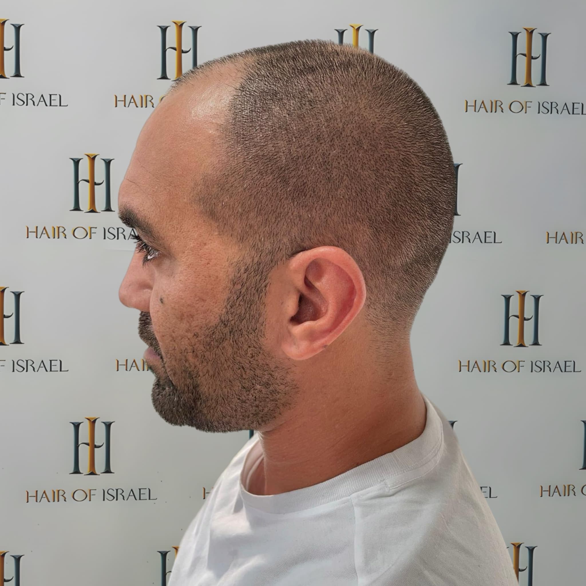 לפני השתלה — מטופל 2