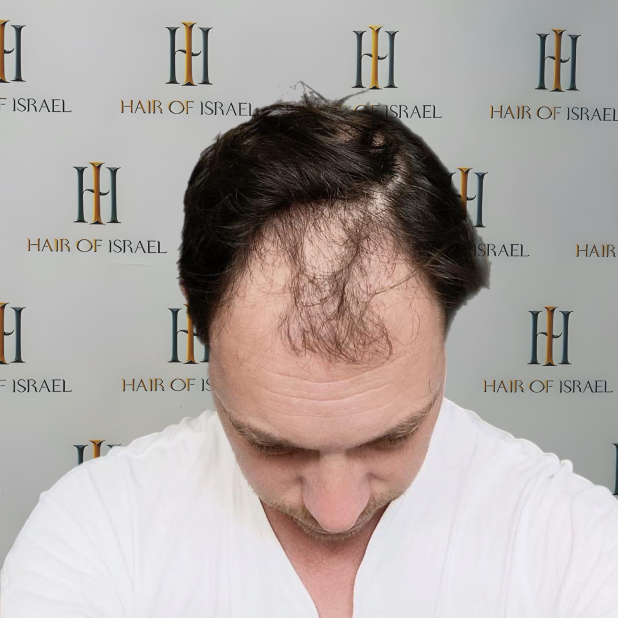 לפני השתלה — מטופל 4