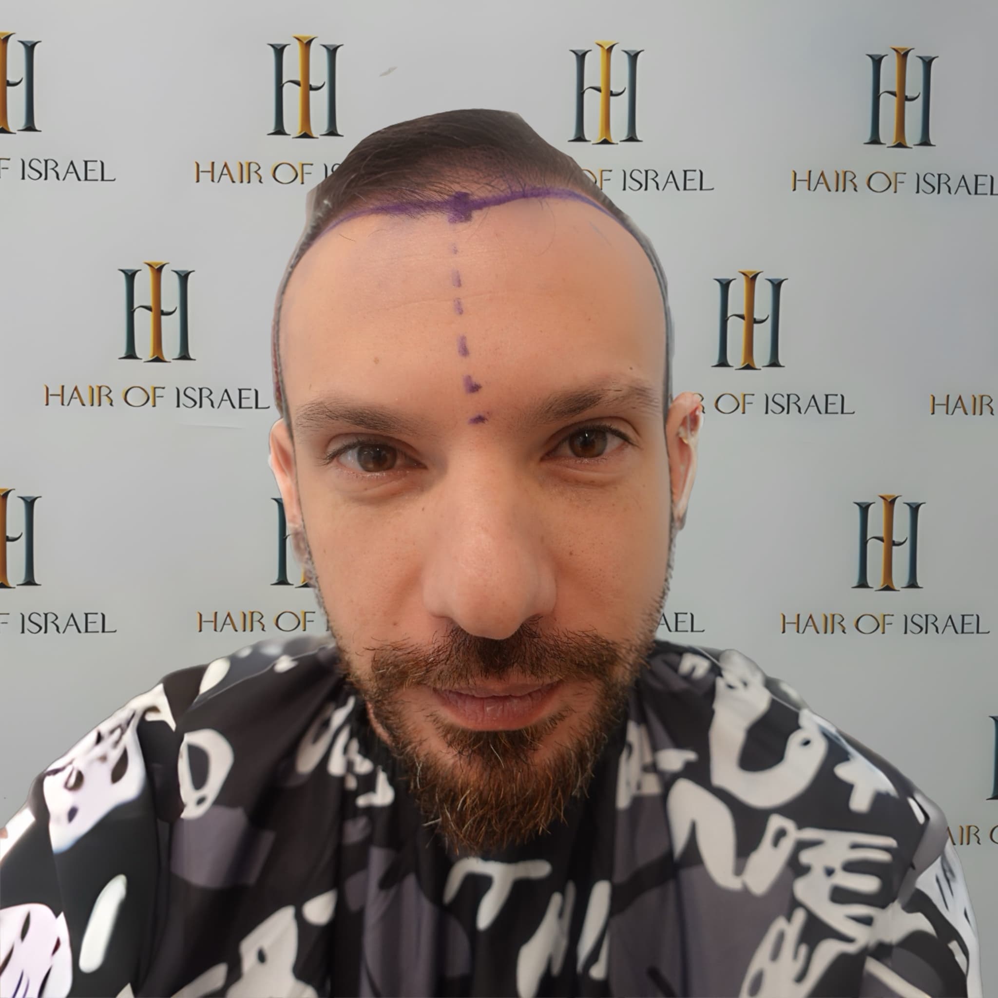 לפני השתלה — מטופל 5